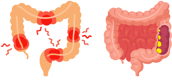 Graphic of inflammatory bowel disease (IBD) and Colorectal Cancer (CRC)
