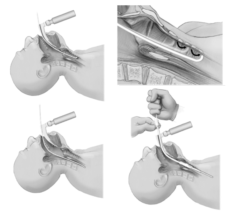 Bougie Assisted Intubation