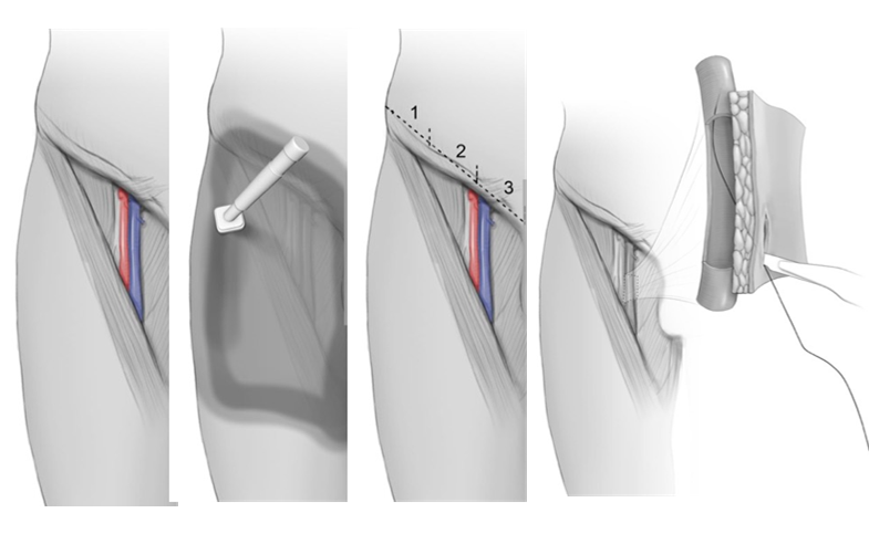 CVA Femoral