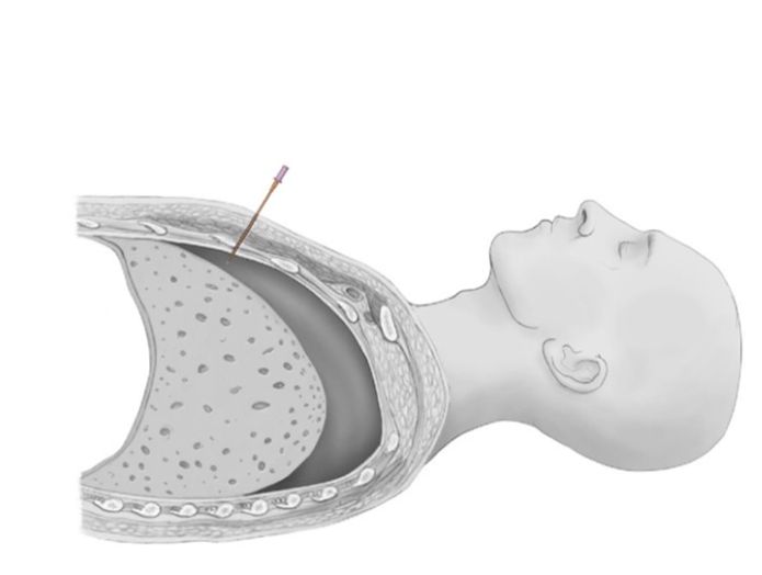 Needle Thoracostomy