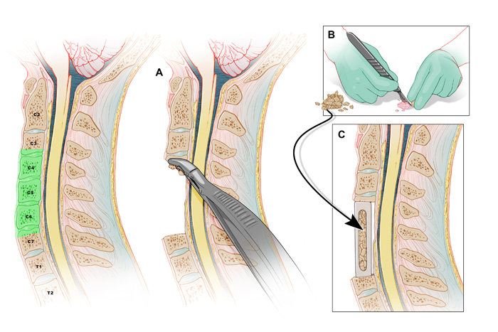 bone harvesting composite