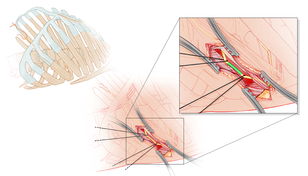 intercoastal brain biopsy