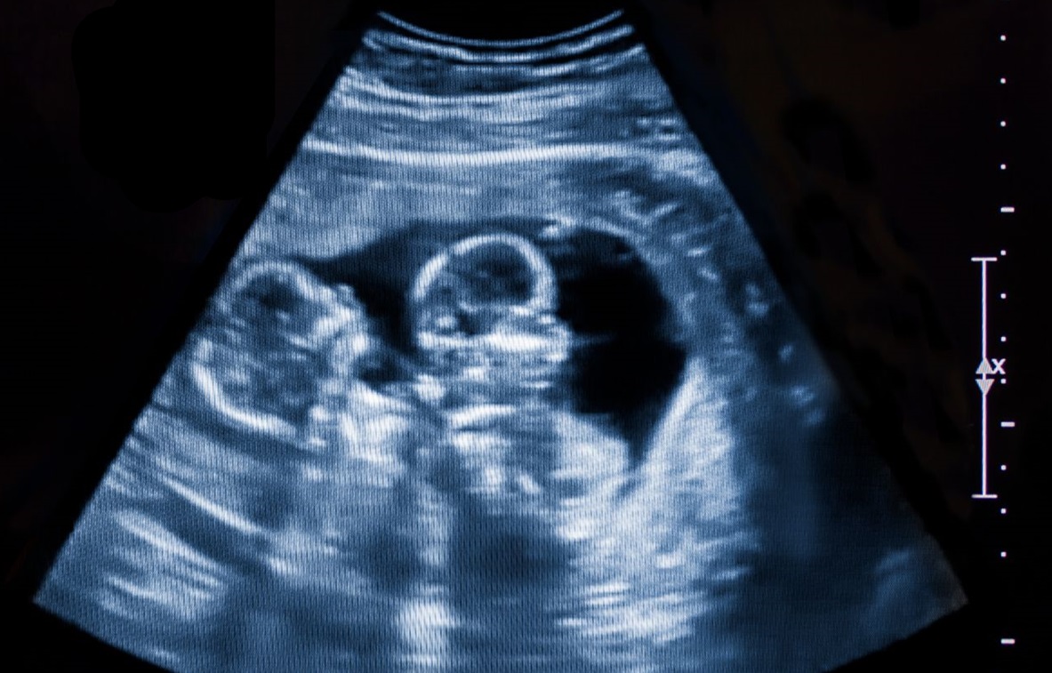 Ultrasound of twins